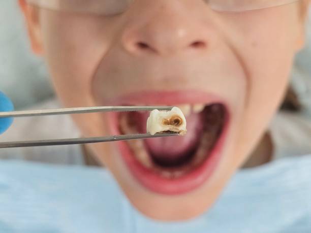 Best Emergency Dentist for Knocked-Out Tooth in Laurel, MD